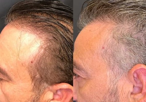 The New Science of Hair Restoration: Why Thousands Are Ditching Surgery for Regenerative Treatments